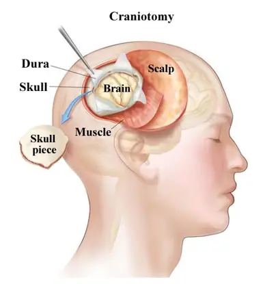 Craniotomy