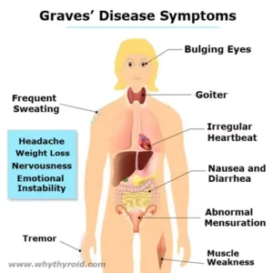 Graves’ Disease Symptoms