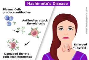 Hashimoto’s Disease