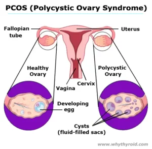 Polycystic-Ovary-Syndrome-PCOS