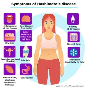 Symptoms of Hashimoto’s disease