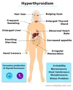 Symptoms of Hyperthyroidism